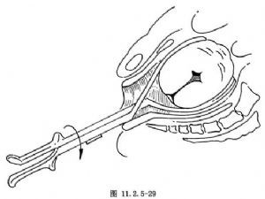 产钳术_英文_拼音_什么是产钳术_医学百科