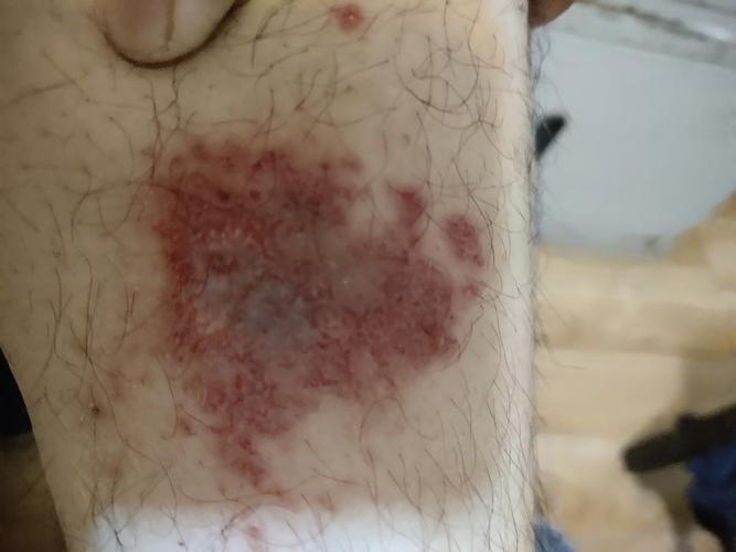 这是刚开始,感觉像毛囊炎