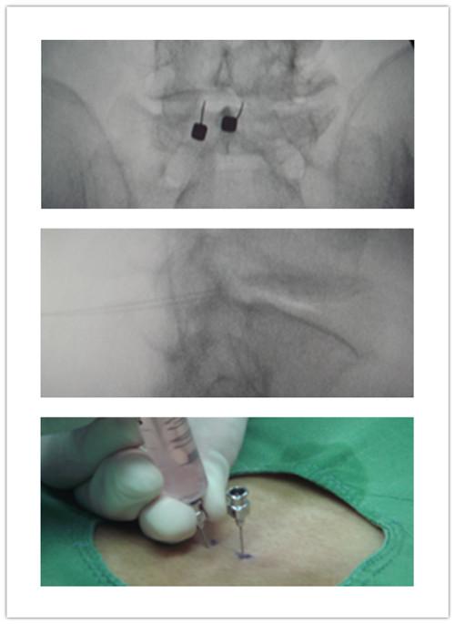 针越过腰椎椎旁关节内缘,突破黄韧带到达腰椎上关节突前缘,进入侧隐窝