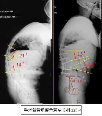 强直性脊柱炎后凸畸形