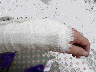 谁有胳膊包纱布图片,百度没有的那种?