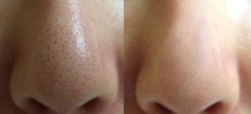 从我的第一次使用前后对比就能清晰地看到加来这款去黑头净化套装