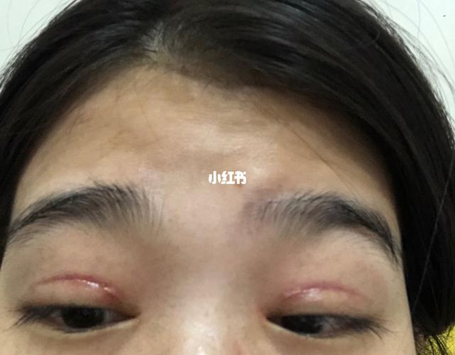 双眼皮增生_双眼皮_双眼皮手术_全切双眼皮_美妆_医美