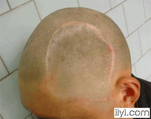 头皮扩张术在头皮缺损颅骨外露修复中的应用