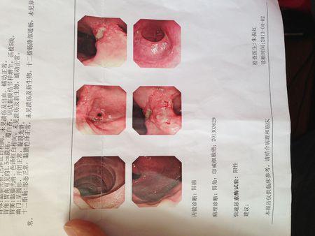 胃角1.5公分胃癌,属于早期中期还是晚期