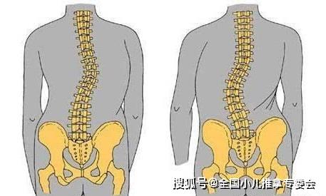 孩子高低肩驼背?小心脊柱侧弯!专家呼吁关爱儿童脊柱健康!