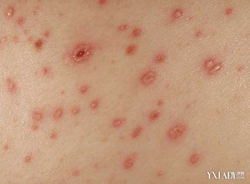 【图】瘙痒性皮肤病是怎样的 介绍2大类临床表现