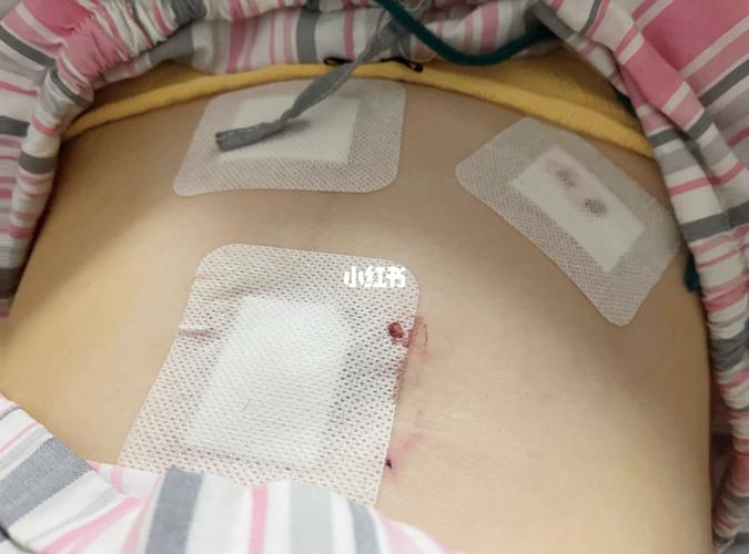 阑尾炎微创手术_疤痕_祛疤膏_祛疤_医疗健康_医疗健康