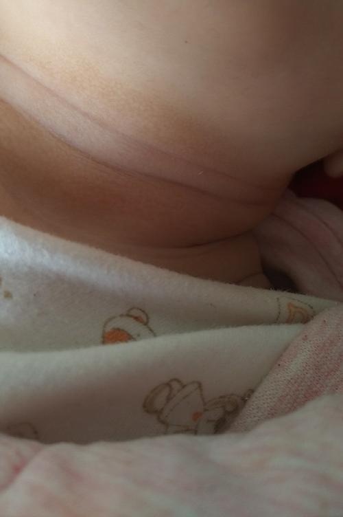 这两天发现宝宝脖子下面长了跟灰一样的东西不知道是什么,洗不掉的,有