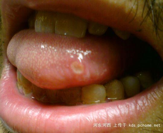 舌头溃疡