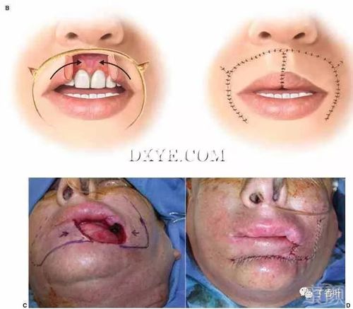 获得性唇畸形的修复