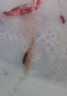 这是肺结核吗?吐痰带着黑色的血块 请各位帮帮我