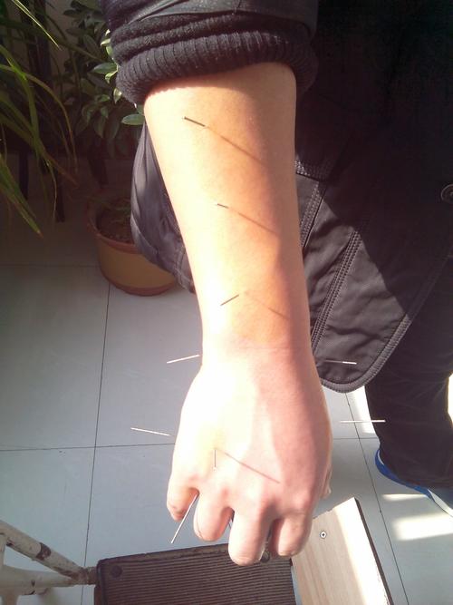 耳聋 针灸师给我手上扎了9针 求行家帮我看看都是哪些穴位