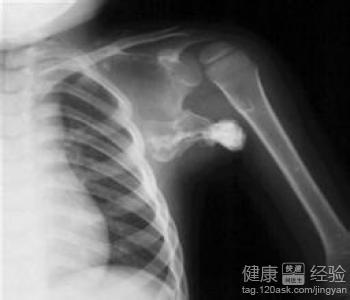 骨癌的并发症有哪些