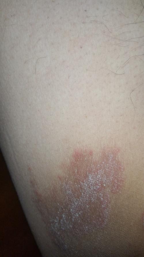 请问这是什么炎症(大腿内侧)?不知道是股癣还是湿疹.