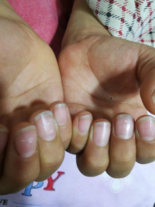 11岁小孩指甲盖上出现白点,是什么原因?