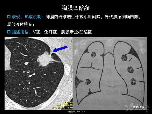 巧用ct及胸片识破肺炎症结核和肺肿瘤