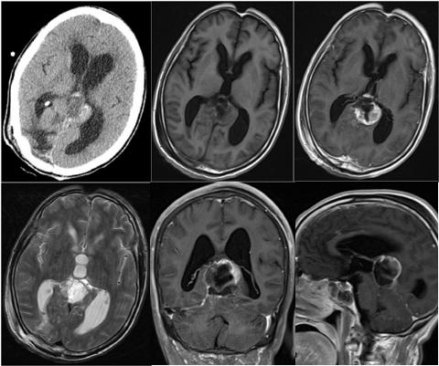 松果体区脑膜瘤一例(神经肿瘤系列十六)---浙二神外周刊(第294期)