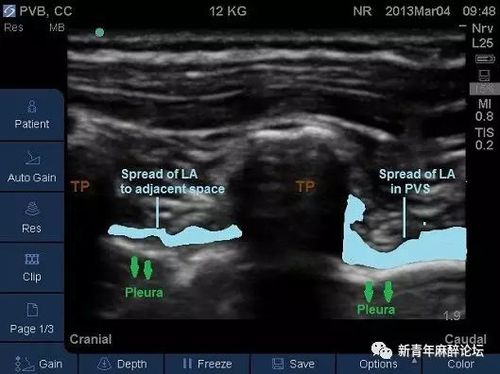 徐医附院麻醉科超声引导下竖脊肌平面阻滞