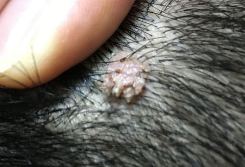 头上长了两个肉芽(或者叫肉刺) ,无痛感,手欠老抠,抠掉一根肉芽会流血