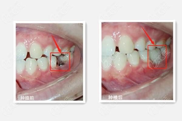 沈阳米兰口腔贾楠医生种植牙技术很赞,看完贾院长种牙