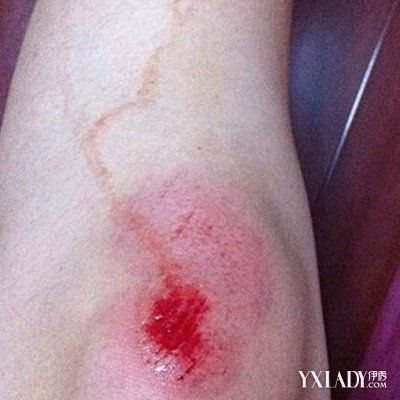 【图】盘点膝盖擦伤图片 7招教你快速处理伤口