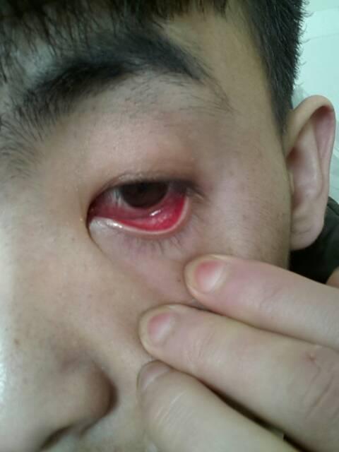 今天早上起来,眼睛好红啊!怎么回事?