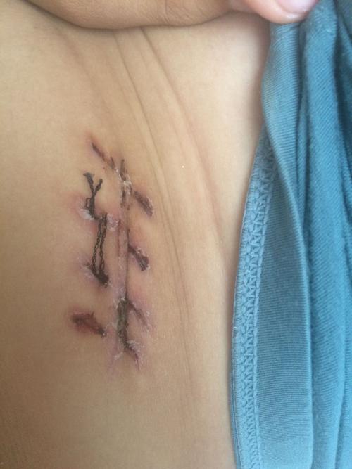 这个阑尾炎手术后刀口恢复的怎么样我已经拆2根线