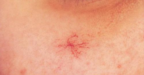 最后,大家区分一下:樱桃状血管瘤vs蜘蛛痣