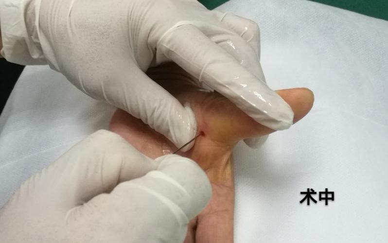 小针刀治疗屈指肌狭窄性腱鞘炎(扳机指)