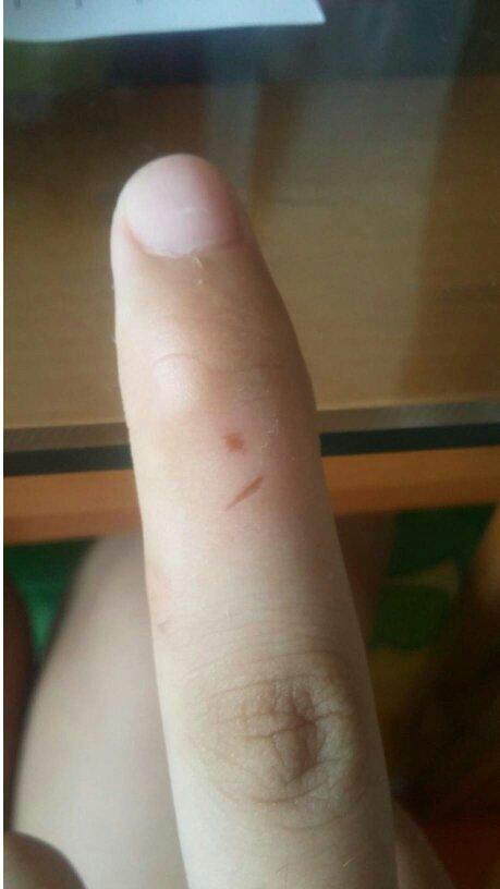 这是被仓鼠咬伤的吗