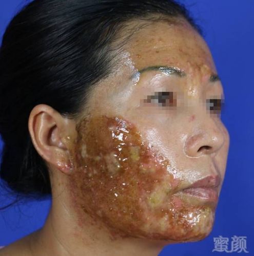 虽然效果不太显著,但一直也没什么大问题,美容院也告诉我皮肤的问