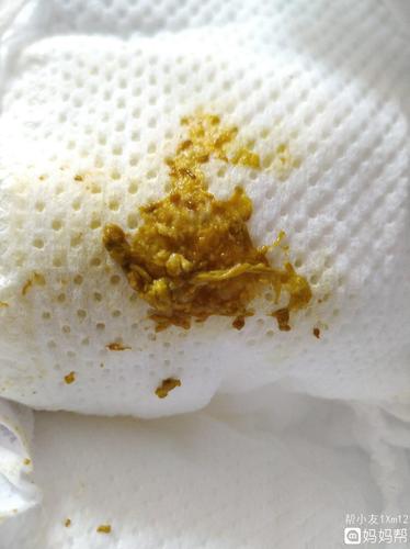 这个样子是否正常呢.感觉像有人说的有奶瓣对吗?需要怎么改善呢?