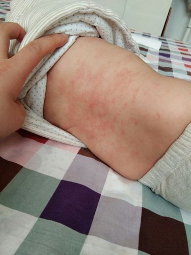 四个月宝宝,母乳喂养,干性湿疹比较厉害,有什么好的治疗方法吗?急