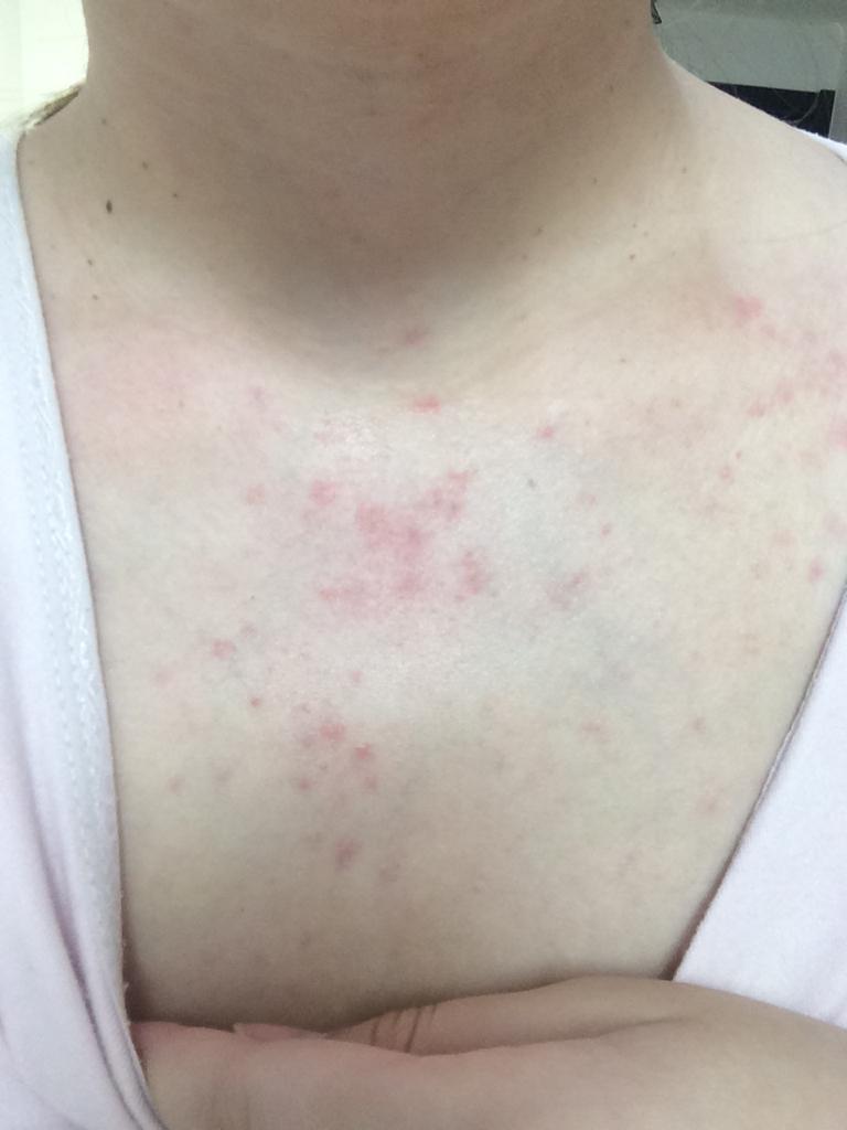 就脖子下面胸口上面长了一片小红疙瘩,特别痒,不知道是过敏还是什么