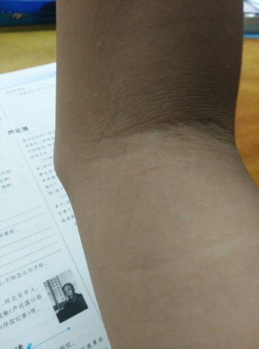 手肘内侧的骨头很提出,平时手放桌上做作业用电脑都很