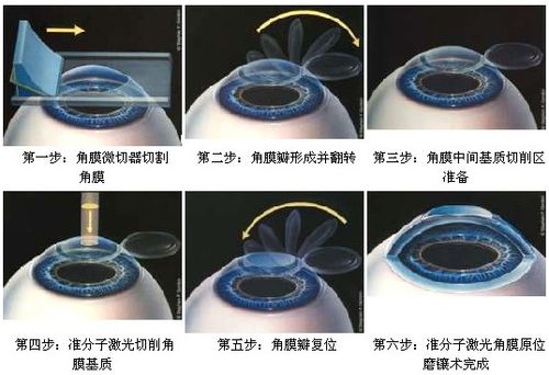 北京希玛林顺潮眼科准分子激光近视手术好不好?