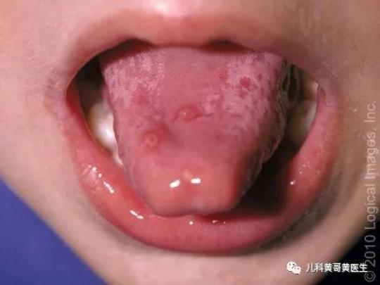 舌头上水泡口腔的上颚许多红色水泡,舌苔很厚,有时候舌头上也有疱疹