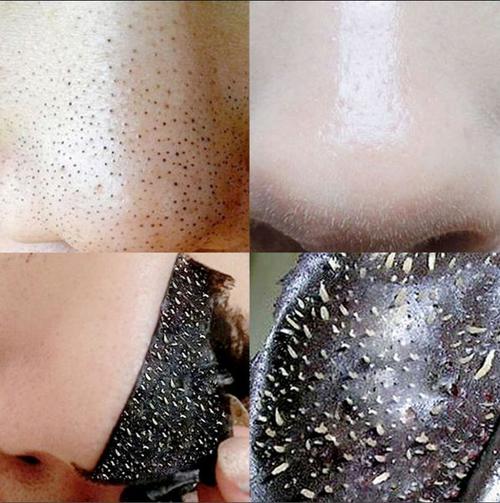 片5 祛粉刺吸黑头竹炭小猪黑头三部曲吸黑头鼻膜 撕拉式去黑头鼻贴