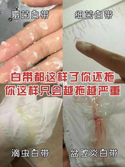 内裤上总是脏脏的,排出来跟豆腐渣一样的分泌物,过了几天竟然私处还痒