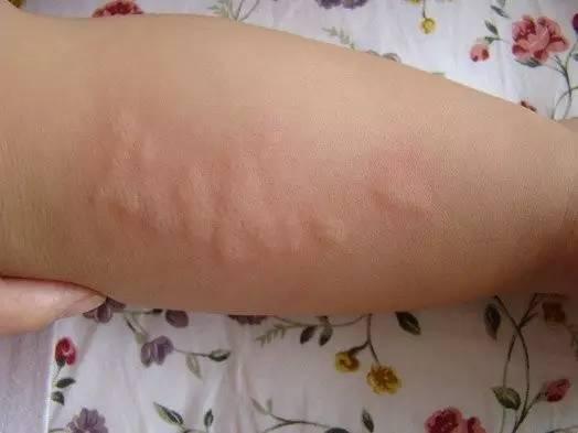 宝宝科普:湿疹,痱子,荨麻疹,水痘等区别与护理