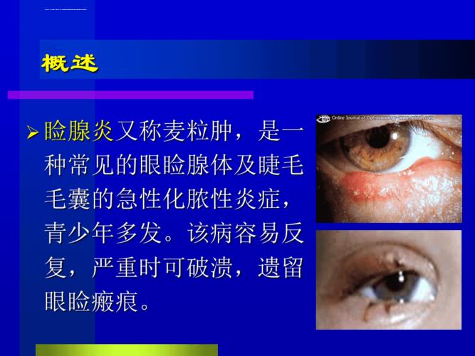 睑腺炎-麦粒肿ppt课件