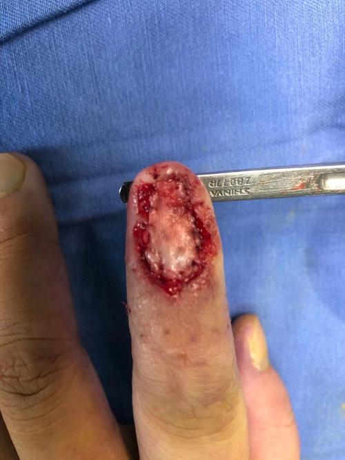 手术方式简单,局部麻醉下可进行,2.若甲根留存可再次有甲板生长3.