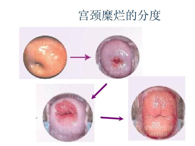 宫颈糜烂的分度