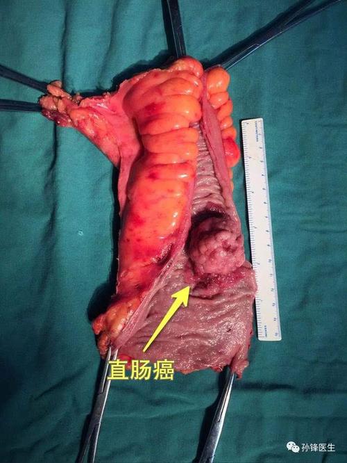 医学科普|直肠癌到底有什么分期?我们家病人是早期还是晚期?能活多久?