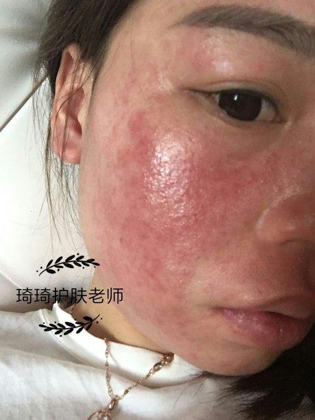 相关搜索 激素脸的症状 面部玫瑰痤疮 过敏肌肤 皮肤水疱 红血丝肌肤