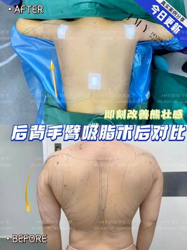 后背吸脂_吸脂_后背吸脂_减肥_减肥医药