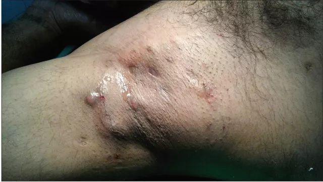 图 6 化脓性汗腺炎   讨论   目前,许多保守疗法在治疗腋窝