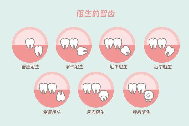 怕疼不想拔智齿?这样做能少看牙医_湃客_澎湃新闻
