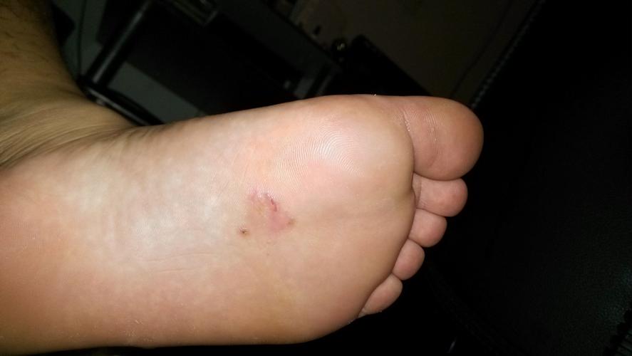 脚掌有块皮肤溃烂了,有图